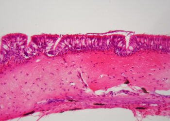 Ependimoma: simptomai, gydymas, prognozė ir tipai