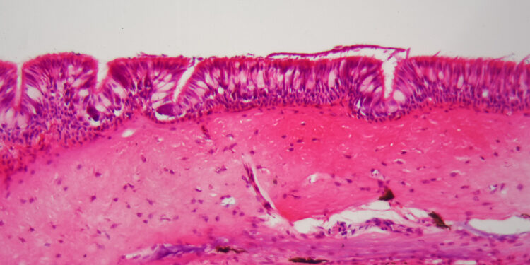 Ependimoma: simptomai, gydymas, prognozė ir tipai