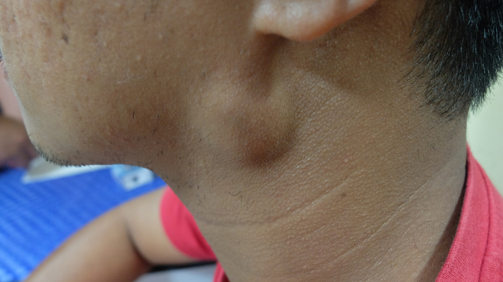 Šakėjimosi užsikimšimas: priežastys, simptomai ir gydymas