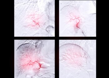 Skaidrių ląstelių sarkoma: simptomai, priežastys ir gydymas