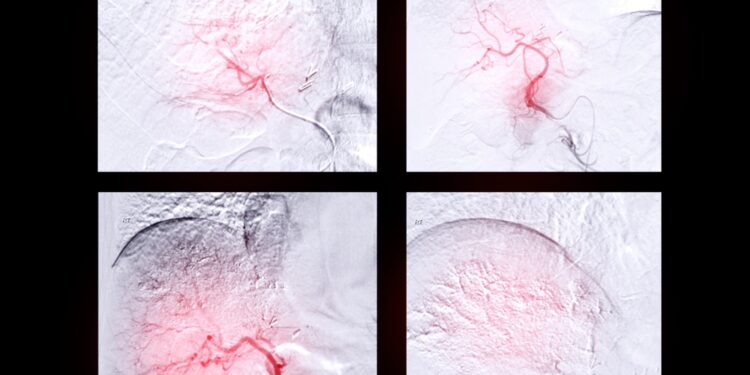 Skaidrių ląstelių sarkoma: simptomai, priežastys ir gydymas