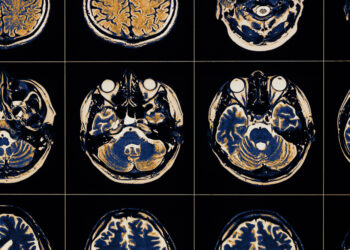 Smegenėlių insultas: kas tai, priežastys, simptomai ir gydymas