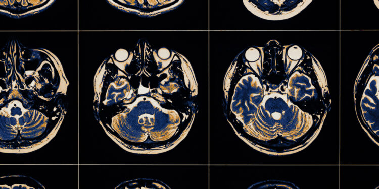 Smegenėlių insultas: kas tai, priežastys, simptomai ir gydymas