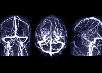 Smegenų veninių ančų trombozė (SVAT): priežastys ir gydymas