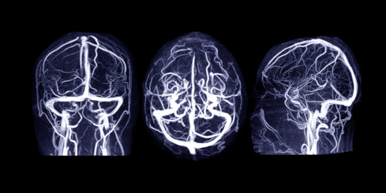Smegenų veninių ančų trombozė (SVAT): priežastys ir gydymas