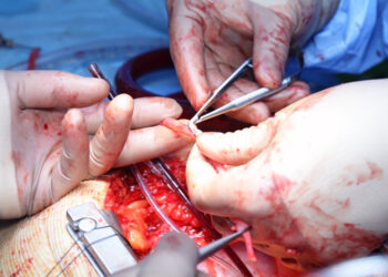 Širdies šuntai: rūšys ir gydymas