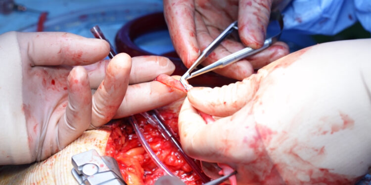 Širdies šuntai: rūšys ir gydymas