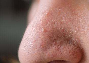 Užsikimšusios poros: kas tai, priežastys, gydymas ir prevencija