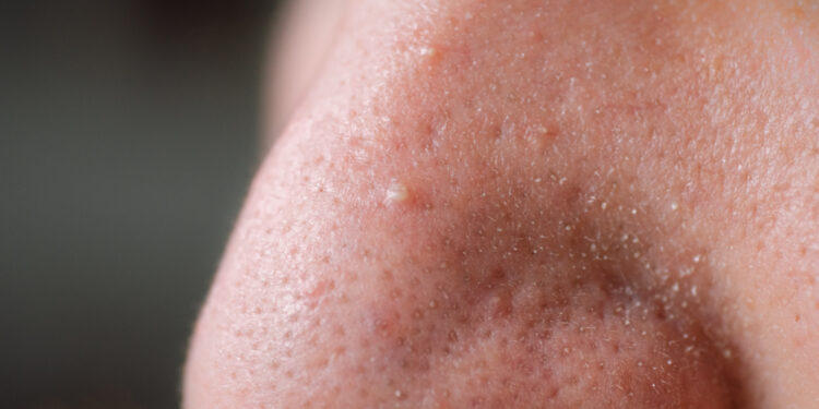 Užsikimšusios poros: kas tai, priežastys, gydymas ir prevencija