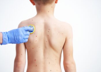 Vėjaraupiai: priežastys, simptomai, gydymas ir profilaktika