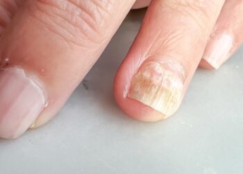 Vėžinė kacheksija: simptomai, gydymas ir prognozė