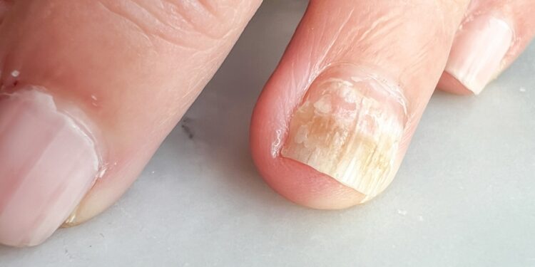 Vėžinė kacheksija: simptomai, gydymas ir prognozė