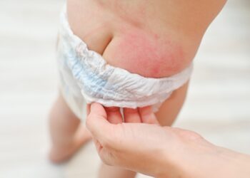 Sauskelnių bėrimas: simptomai, priežastys ir gydymas