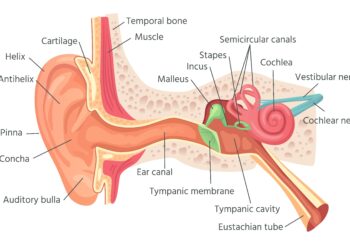 Perilimfinė fistulė (PLF): radiologiniai požymiai, simptomai ir gydymas
