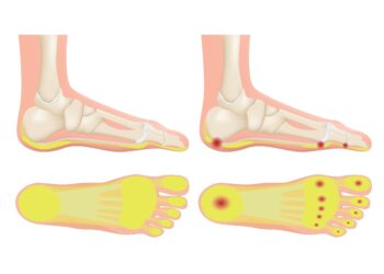 Kulno riebalų pagalvėlės sindromas: simptomai, priežastys ir gydymas