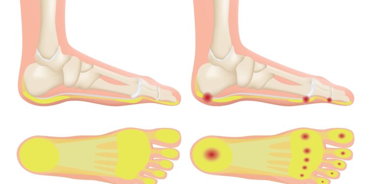 Kulno riebalų pagalvėlės sindromas: simptomai, priežastys ir gydymas