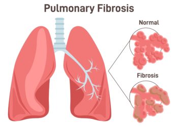 Aukštuminė plaučių edema (HAPE): priežastys ir gydymas