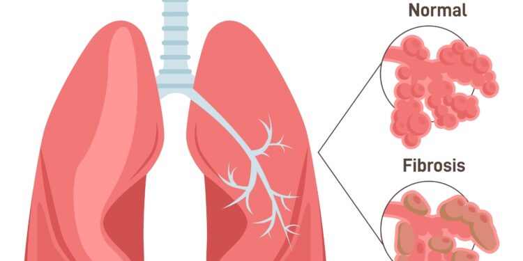 Aukštuminė plaučių edema (HAPE): priežastys ir gydymas