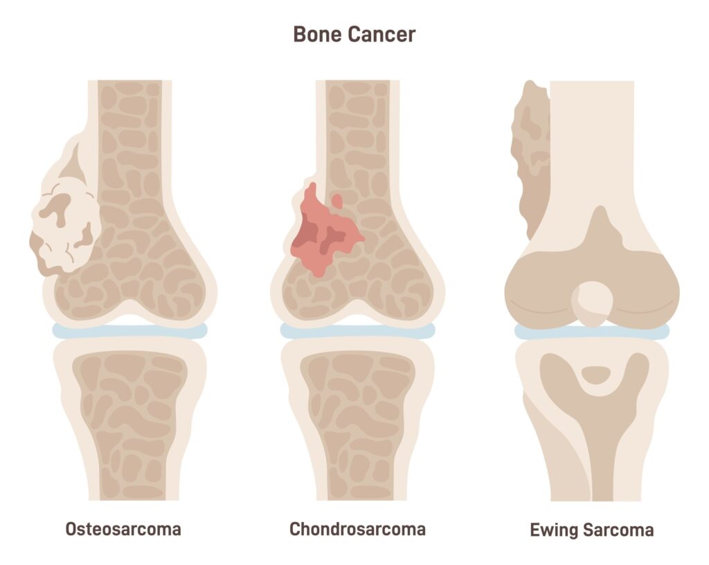 Osteosarkoma (kaulų vėžys): simptomai ir gydymas