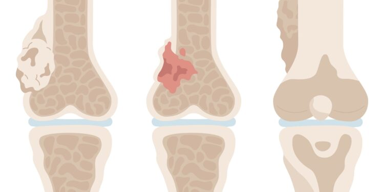 Osteosarkoma (kaulų vėžys): simptomai ir gydymas
