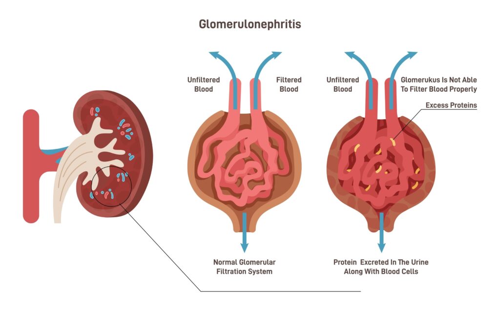 Echinokokozė: Priežastys, simptomai ir gydymas