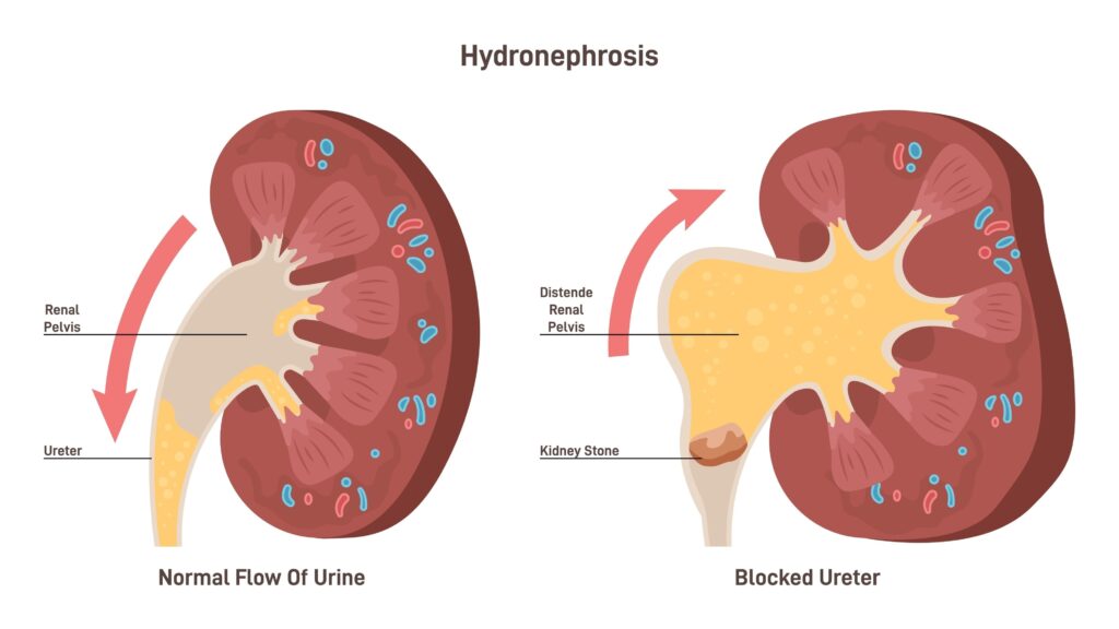 Hidronfrozė: priežastys, simptomai, diagnostika ir gydymas