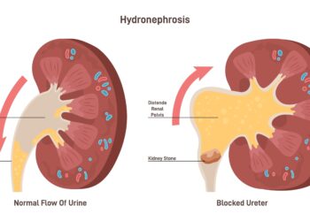 Hidronfrozė: priežastys, simptomai, diagnostika ir gydymas