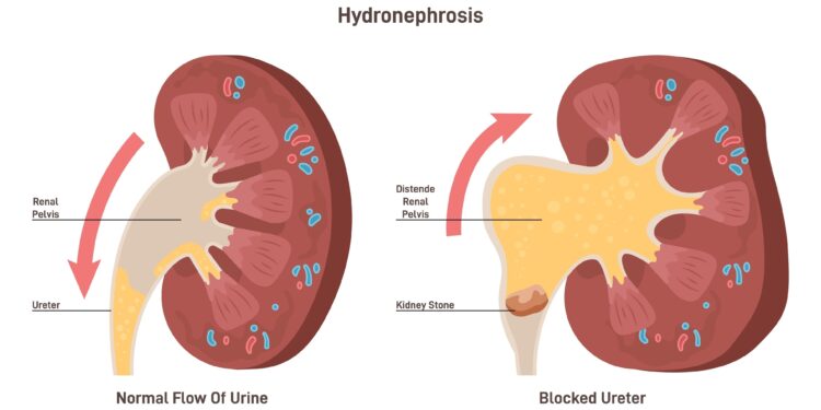 Hidronfrozė: priežastys, simptomai, diagnostika ir gydymas