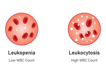 Hemofagocitinė limfohistiocitozė: simptomai, priežastys ir prognozė