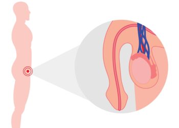 Varpos sukamasis iškrypimas: priežastys, simptomai ir gydymas