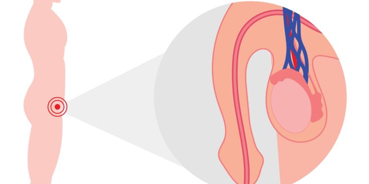 Varpos sukamasis iškrypimas: priežastys, simptomai ir gydymas