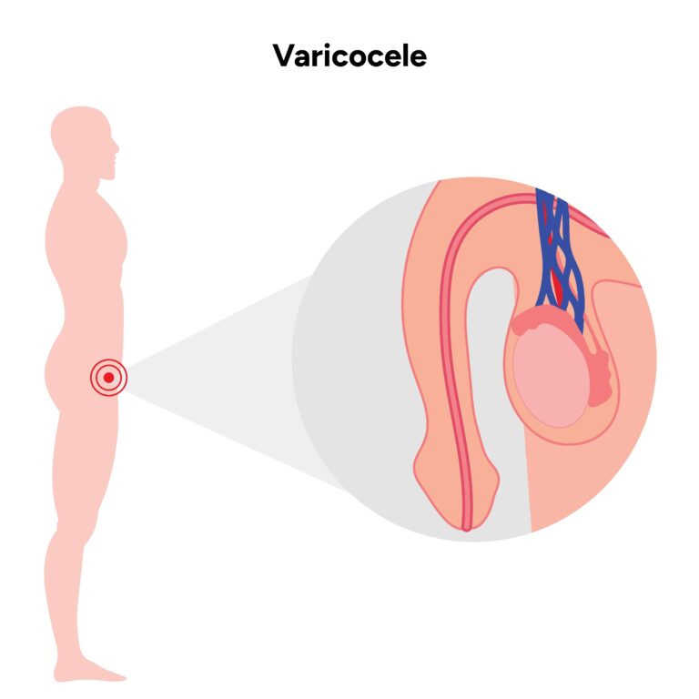 Varpos sukamasis iškrypimas: priežastys, simptomai ir gydymas