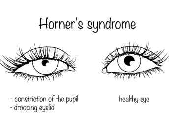 Hornerio sindromas: kas tai, priežastys, simptomai ir gydymas