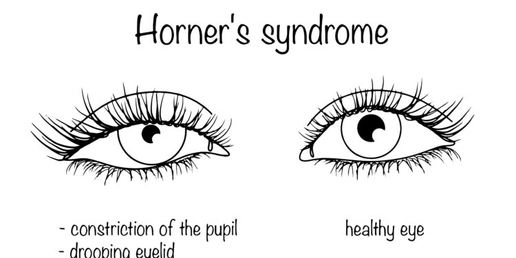 Hornerio sindromas: kas tai, priežastys, simptomai ir gydymas