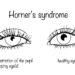 Hornerio sindromas: kas tai, priežastys, simptomai ir gydymas