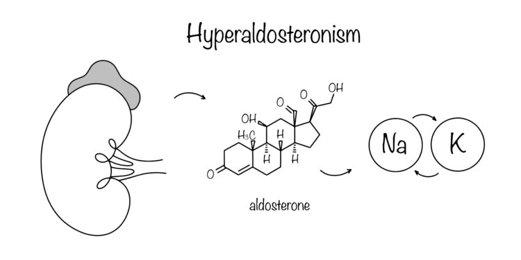 Hiperaldosteronizmas: kas tai, priežastys, simptomai ir gydymas