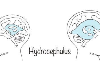 Hidranencefalija: priežastys, simptomai, diagnostika ir gydymas