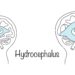 Hidranencefalija: priežastys, simptomai, diagnostika ir gydymas