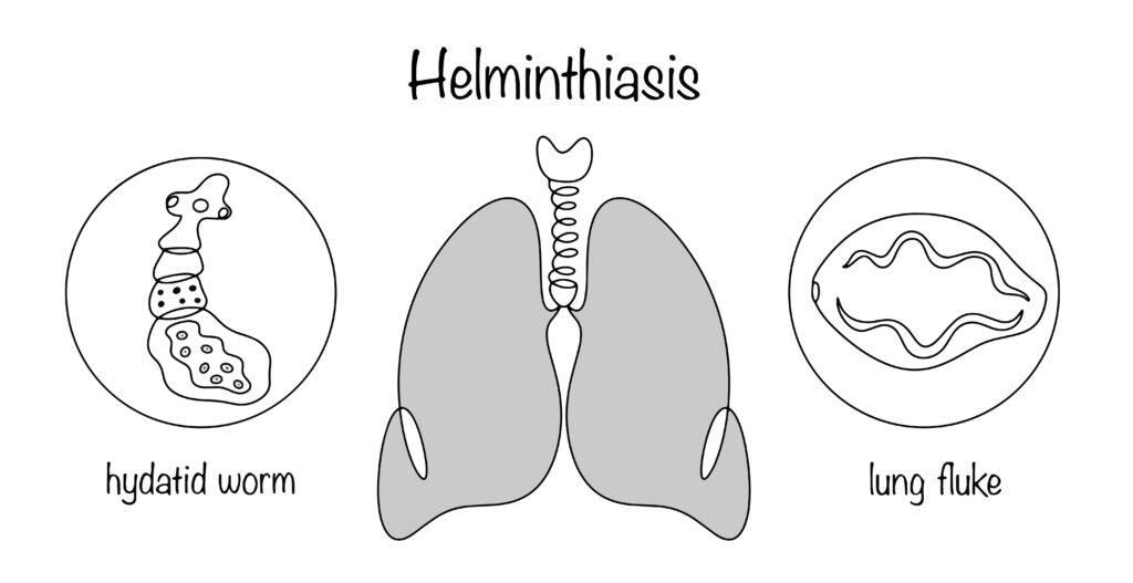 Paragonimozė: priežastys, simptomai, diagnostika ir gydymas