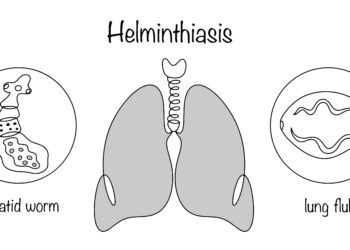 Paragonimozė: priežastys, simptomai, diagnostika ir gydymas