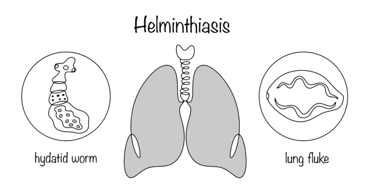 Paragonimozė: priežastys, simptomai, diagnostika ir gydymas