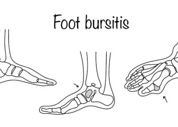 Kulno bursitas: priežastys, tipai, simptomai ir gydymas