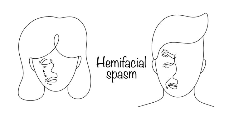 Hemi veido spazmas (veido trūkčiojimas): simptomai, priežastys ir gydymas