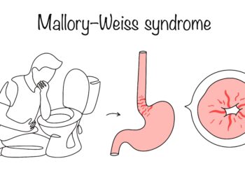 Mallory–Weiss plyšys: simptomai, priežastys, gydymas ir profilaktika