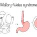Mallory–Weiss plyšys: simptomai, priežastys, gydymas ir profilaktika