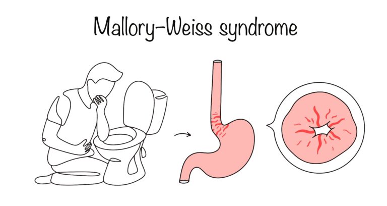Mallory–Weiss plyšys: simptomai, priežastys, gydymas ir profilaktika