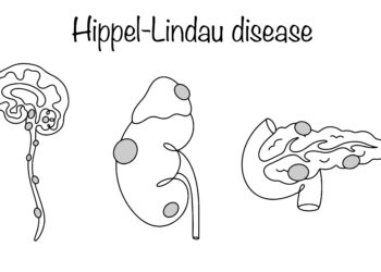 Hemangioblastoma: tipai, radiologija ir patologija