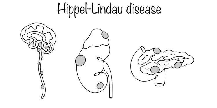 Hemangioblastoma: tipai, radiologija ir patologija