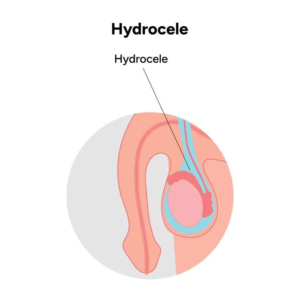 Hidrocelė: priežastys, simptomai, diagnostika ir gydymas