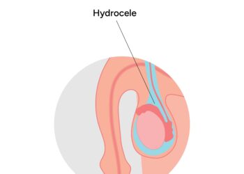Hidrocelė: priežastys, simptomai, diagnostika ir gydymas